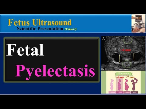 ቪዲዮ: Pyelectasis ዳውን ሲንድሮም ማለት ነው?