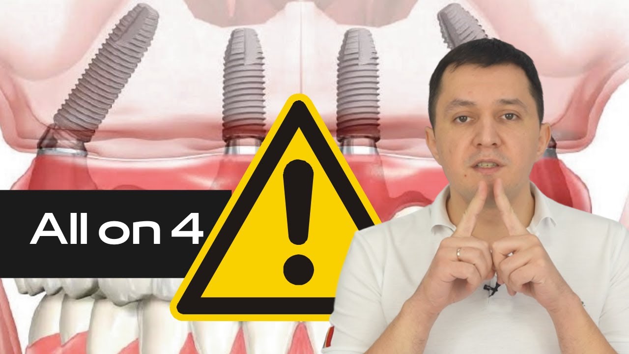 NU ALEGE proteza fixa pe  4 implanturi - ALL ON 4 — până nu vezi acest video