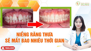 Niềng răng thưa mất bao lâu để răng đều khít? Bác sĩ giải đáp
