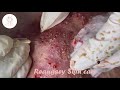 Part 07 - Acne Vulgaris and Extracting large Whiteheads Mp3 Song