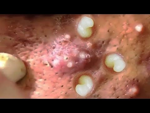 Part 07 - Acne Vulgaris and Extracting large Whiteheads
