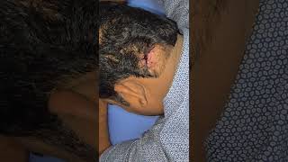Keloid treatment response