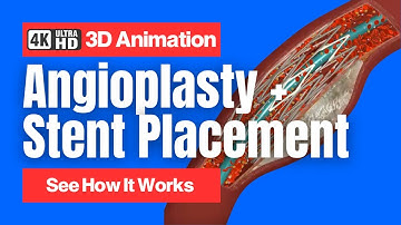 Angioplasty and Stent Placements - See How It Works - 4K 3D Animation