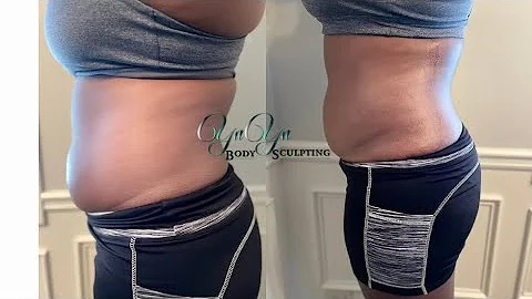 Laser Lipo W/ 14Pads 160mw Lipo Laser Machine | Before and After