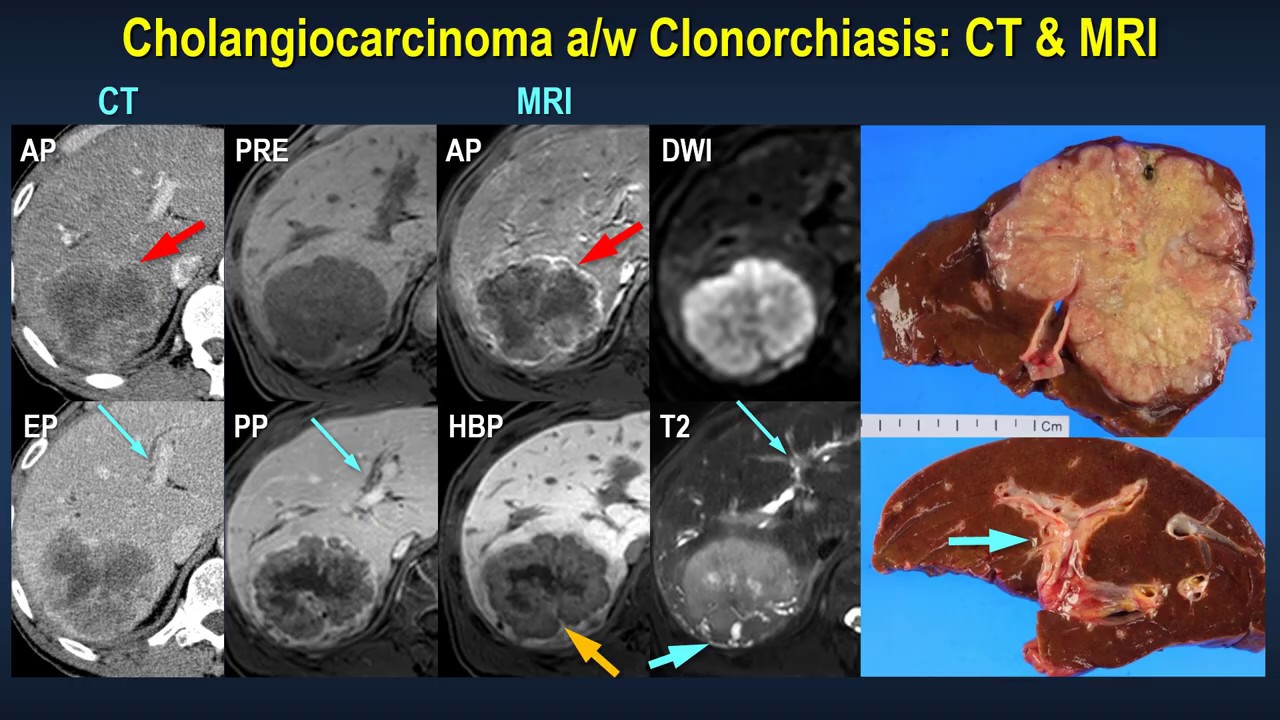 Varying appearances of cholangiocarcinomas according to predisposing ...