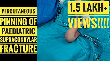 Percutaneous K-wire of Paediatric Supracondylar Humerus fracture