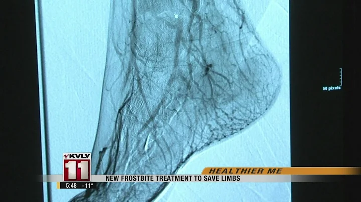 New Frostbite Treatment To Save Limbs