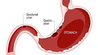 pathophysiology of peptic ulcer||pathophysiology of duodenal ulcer ||BSc nursing 3rd semester #steps