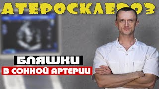 Атеросклероз. Атеросклеротические бляшки.