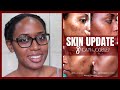 SKIN UPDATE | Hydroquinone+Tretinoin, Hyperpigmentation, Acne, 8mth Product Empties