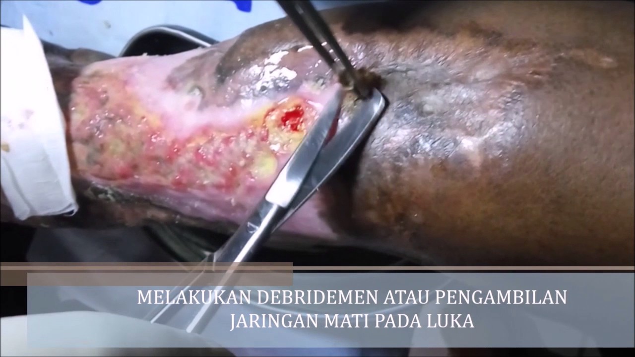 Sekilas tentang Diabetes Melitus