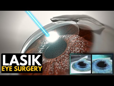ვიდეო: 3 გზა იმის გასაგებად, არის თუ არა ლასიკის თვალის ოპერაცია თქვენთვის