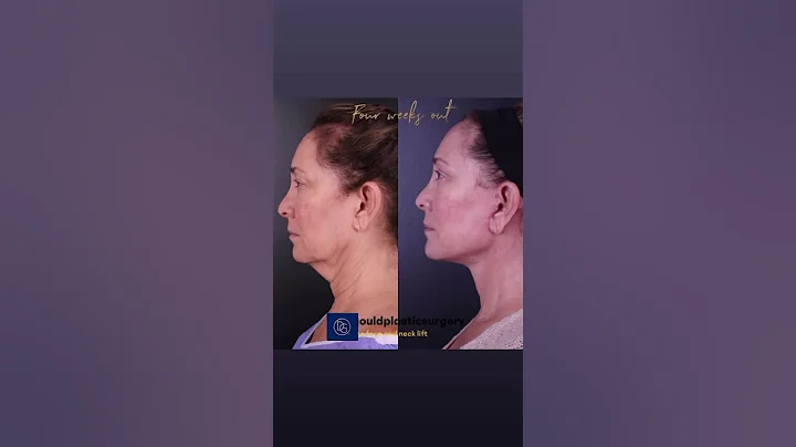 Post op #deepplanefacelift the most advanced #facelift around targeting the #neck #itstheneckforme