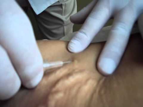 Cuantas inyecciones de carboxiterapia