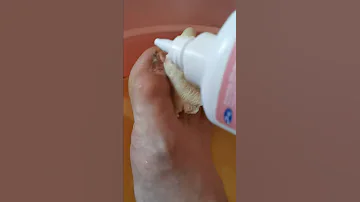 Снятие прилипшей повязки с раны