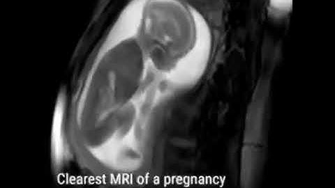 MRI of fetus