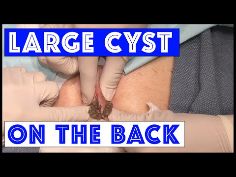 Large Epidermoid Cyst Excised on the Back