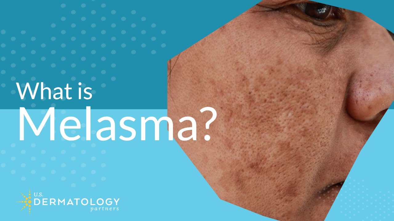 What Is Melasma Melasma Treatment Explained Youtube