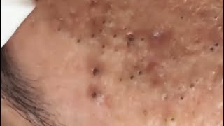 LOOK AT THESE BLACKHEADS ON THE FOREHEAD  😨 PART I #relaxing  #blackheads