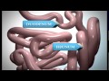 Sleeve Gastrectomy Patient Educational Video