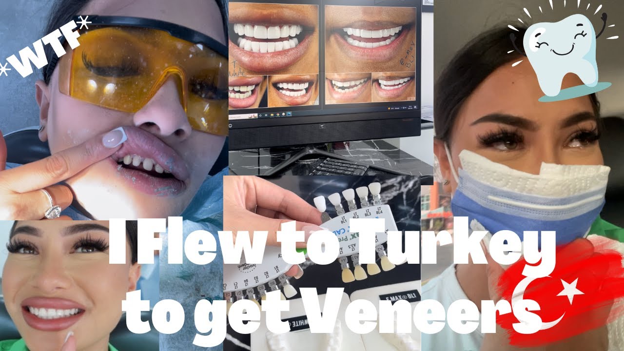 I FLEW TO TURKEY TO GET VENEERS | VENEERS VLOG PART 1