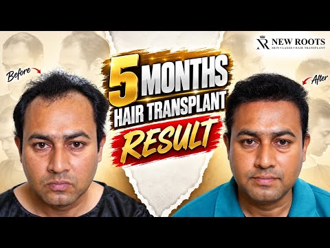 4000 Grafts Hair Transplant Result | Debraj's Real Experience | New Roots