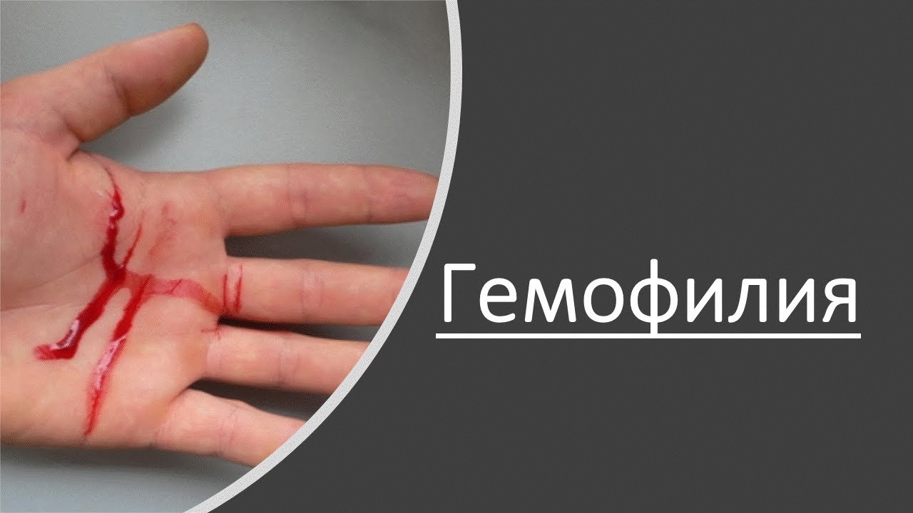 Наследование гемофилии