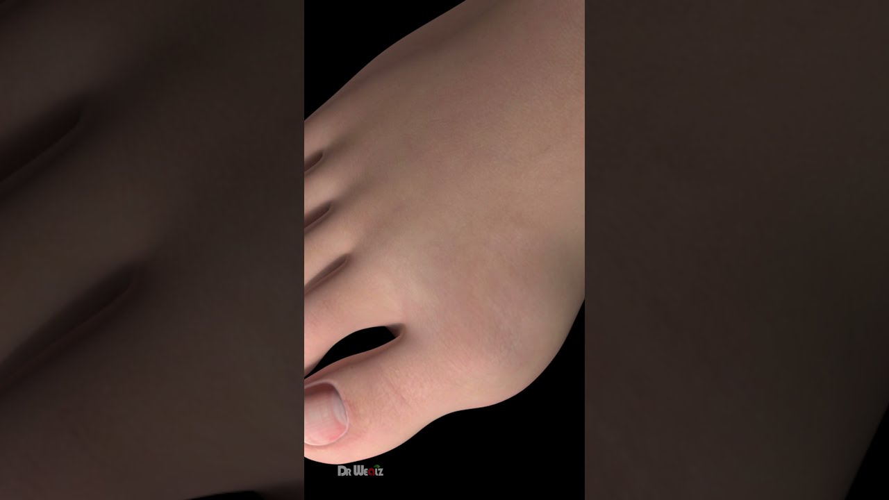 Why Do Some People Get Bunions The Science Behind It