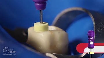 ProTaper NEXT - The Shaping Movement: Advanced Endodontics