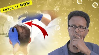 Check these 6 things BEFORE a hair transplant [ or risk FAILURE] 6 Things You Need To Know Before Getting A Hair Transplant