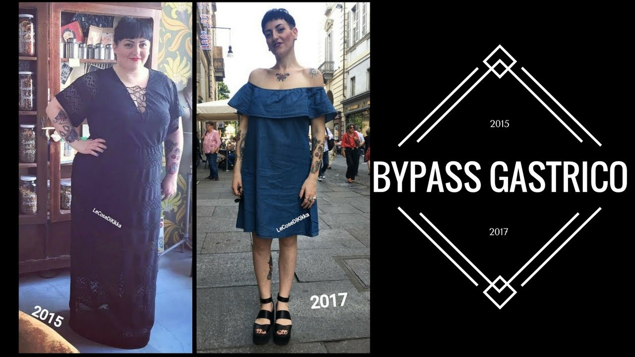 bypass gastrico mensile di perdita di pesona