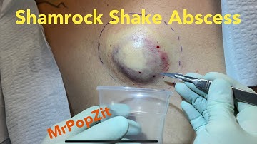 Shamrock shake giant abscess on back. Incision and drainage. Contents collected in cup. MrPopZit.