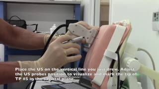Ultrasound Assisted Thoracic Paravertebral Nerve Block
