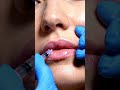 Lip Filler Transformation | Realistic Cosmetic Enhancement