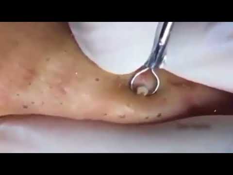 A Field- Full Of Blackheads - Acne Extraction - 