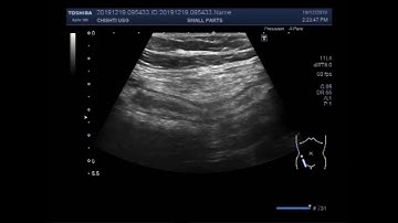 Ultrasound Video showing Focusing of the inflamed Appendix.