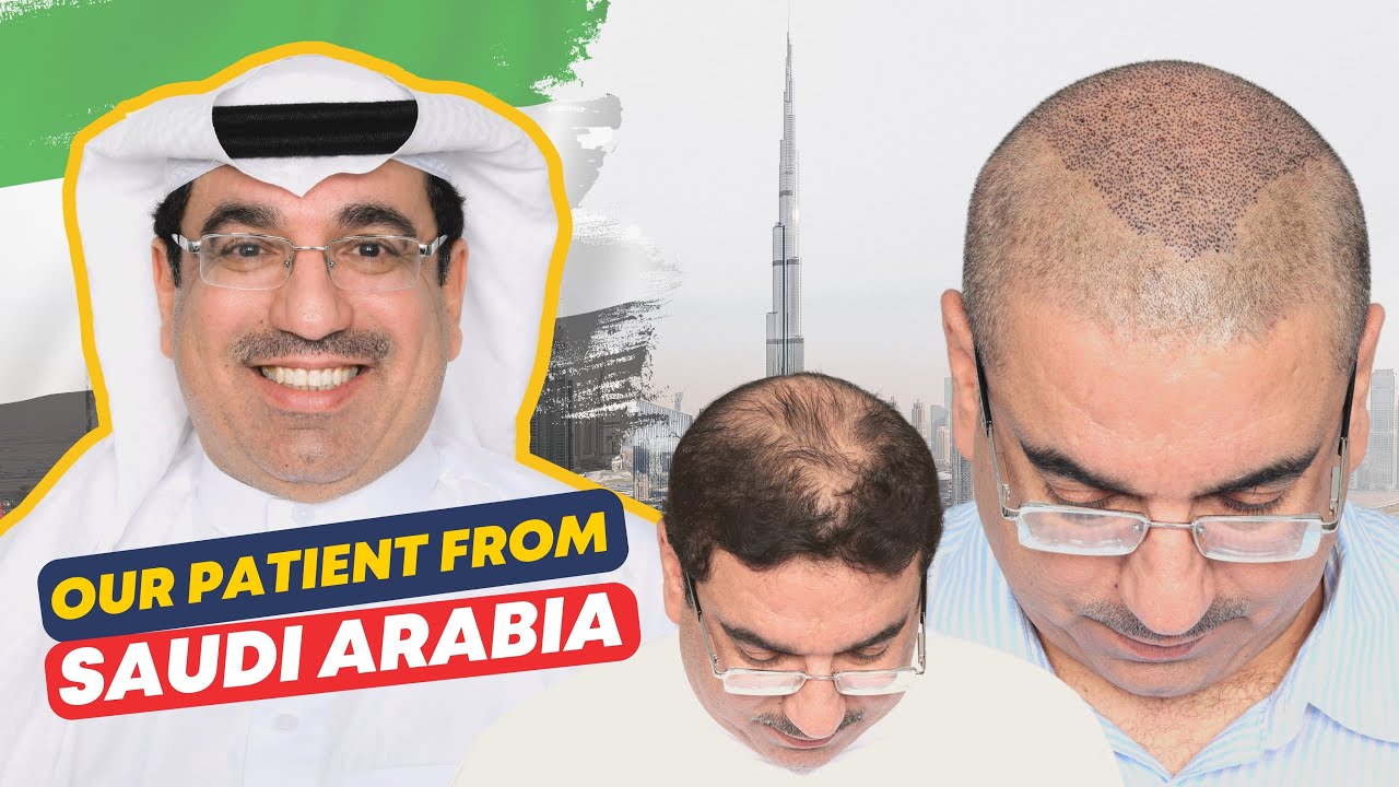 Hair Transplant in Jordan Best Results & Cost of Hair Transplant in Jordan YouTube