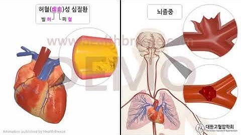 [시연용] l0160adko_[대한고혈압학회] 고혈압에 대해 알아봅시다 (4) 고혈압을 치료해야 하는 이유와 치료목표 혈압