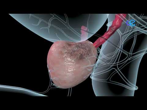 El diagnóstico precoz también es importante para la curación del cáncer de próstata