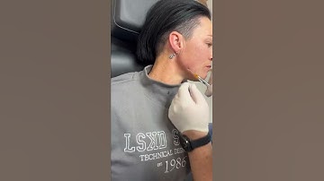 Jawline dermal filler treatment l Newcastle Cosmetic Doctor l Patient desires a sharper jawline.