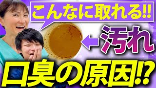 【口臭 汚れ】歯科医師のお口にはこんなに汚れが残っていた！？