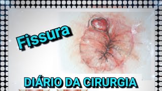 Fissura Anal, Plicoma e Hemorróidas / DIÁRIO DA CIRURGIA Fissura Anal, Plicoma e Hemorróidas / DIÁRIO DA CIRURGIA