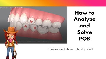 Invisalign ClinCheck - End the struggle with Posterior Open Bite