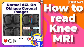 (Fig 2-A.07) Normal ACL on oblique coronal images