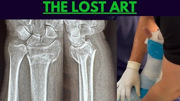 Colles’ Fracture Reduction Masterclass: Step-by-Step Closed Reduction & Plaster Cast Application