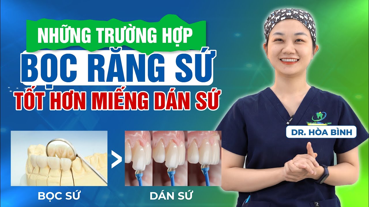 Outline Video TRƯỜNG HỢP NÀO NÊN CHỌN RĂNG SỨ THAY VÌ DÁN SỨ VENEER?