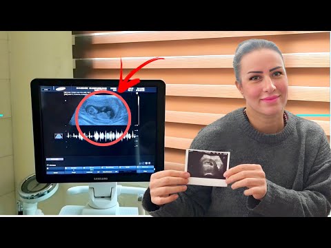 سمعنا نبض البيبي لأول مرة أول مرة نشوف البيبي مؤثر