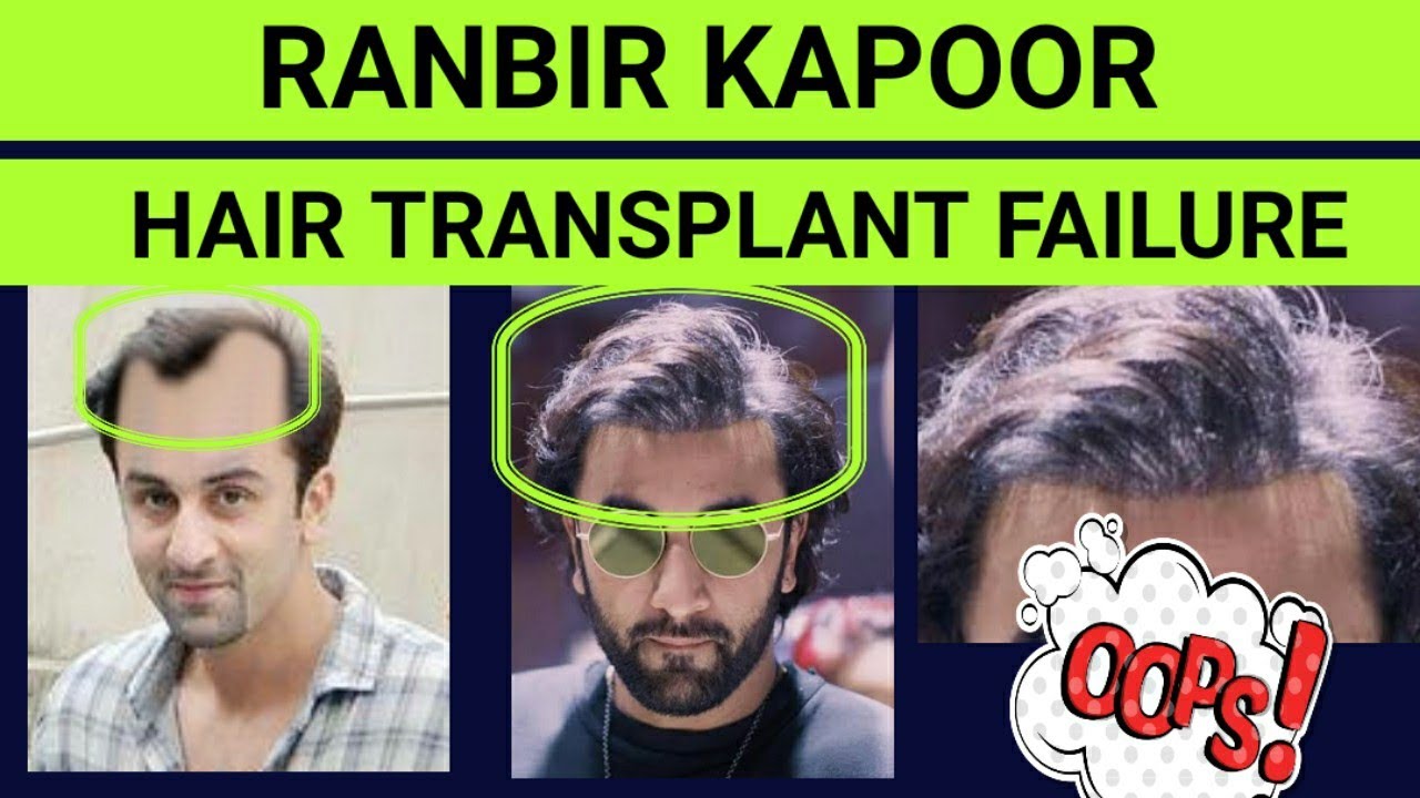 Ranbir kapoor, hair transplant, hair transplant side effects, ranbir kapoor...