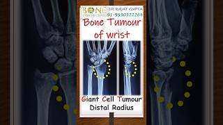 Giant Cell Tumour #GCT Wrist cured successfully-Dr Rajat Gupta @bonecancerclinic #shorts