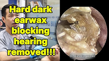Hard dark earwax blocking hearing removed | ear cleaning | ASMR earwax | soothing |relax|